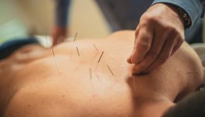 acupuncture